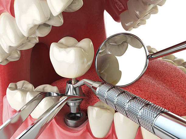 Best Emergency Dentist for Knocked-Out Tooth in Westminster, CO
