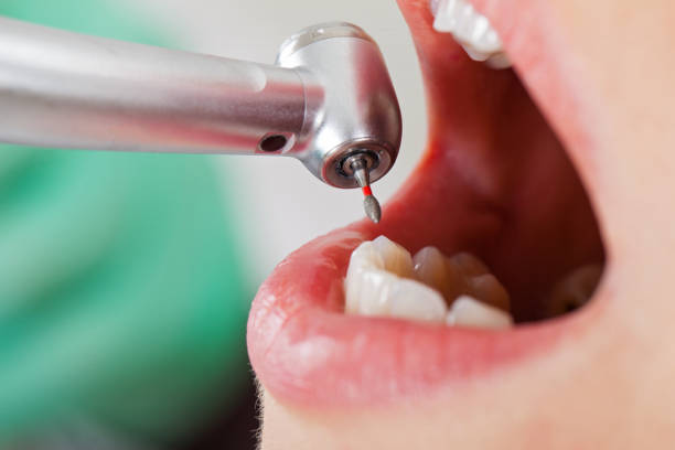 Best Emergency Dentist for Lost Fillings or Crowns in Westminster, CO
